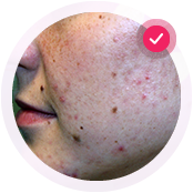 Лечение проблемной кожи